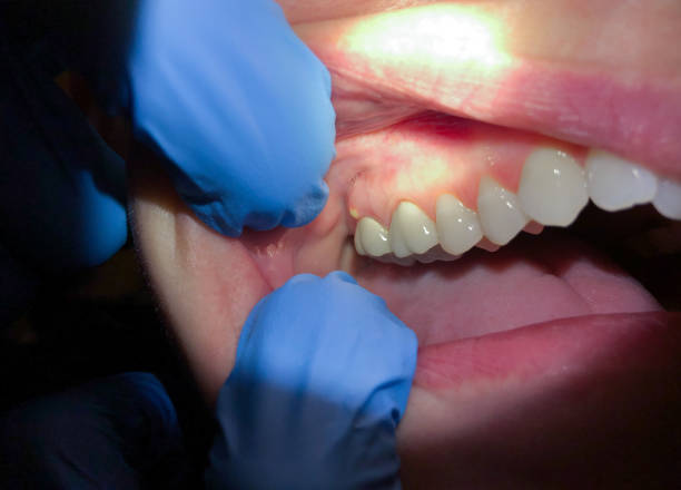 Best Emergency Root Canal Treatment in Celina, TX