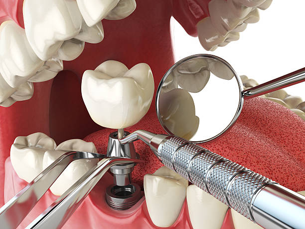 Best Emergency Tooth Extraction in Celina, TX